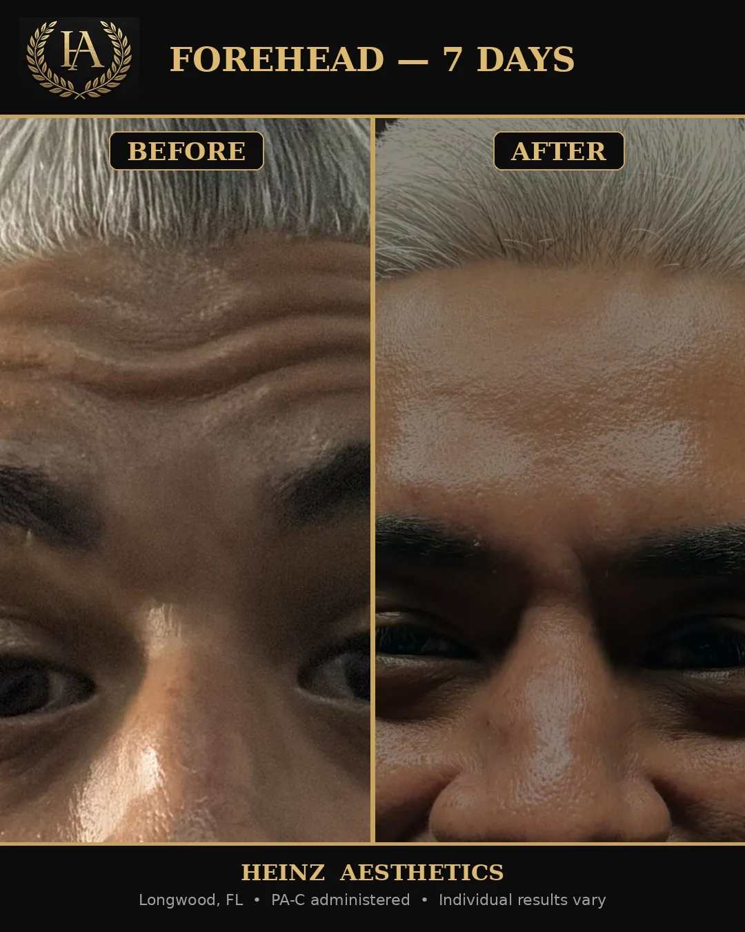 Before and after — forehead lines at seven days
