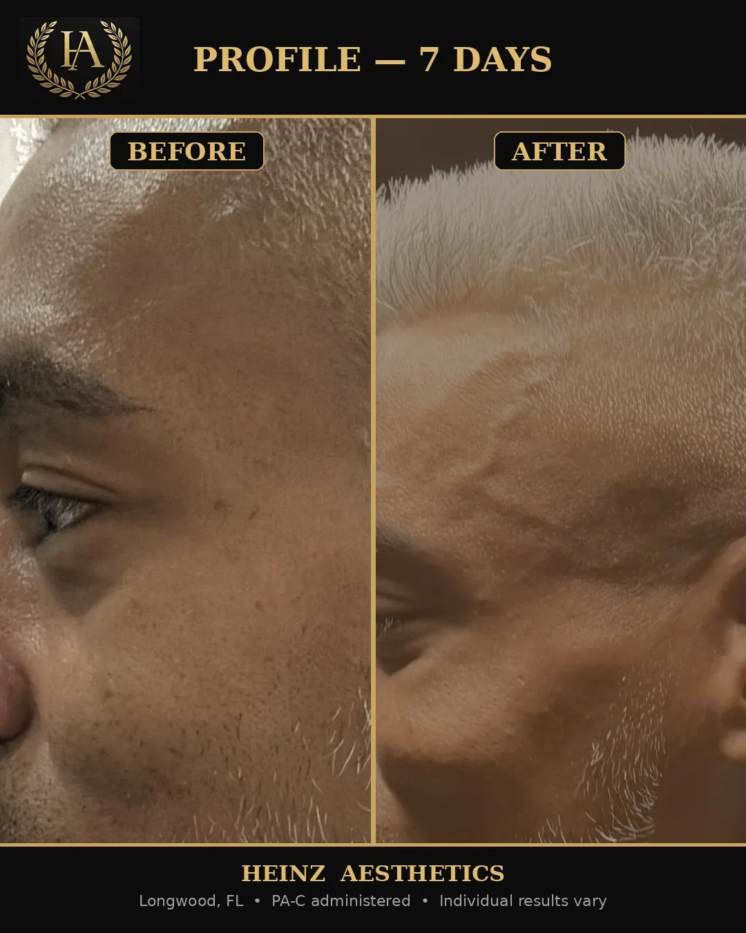 Before and after — profile at seven days